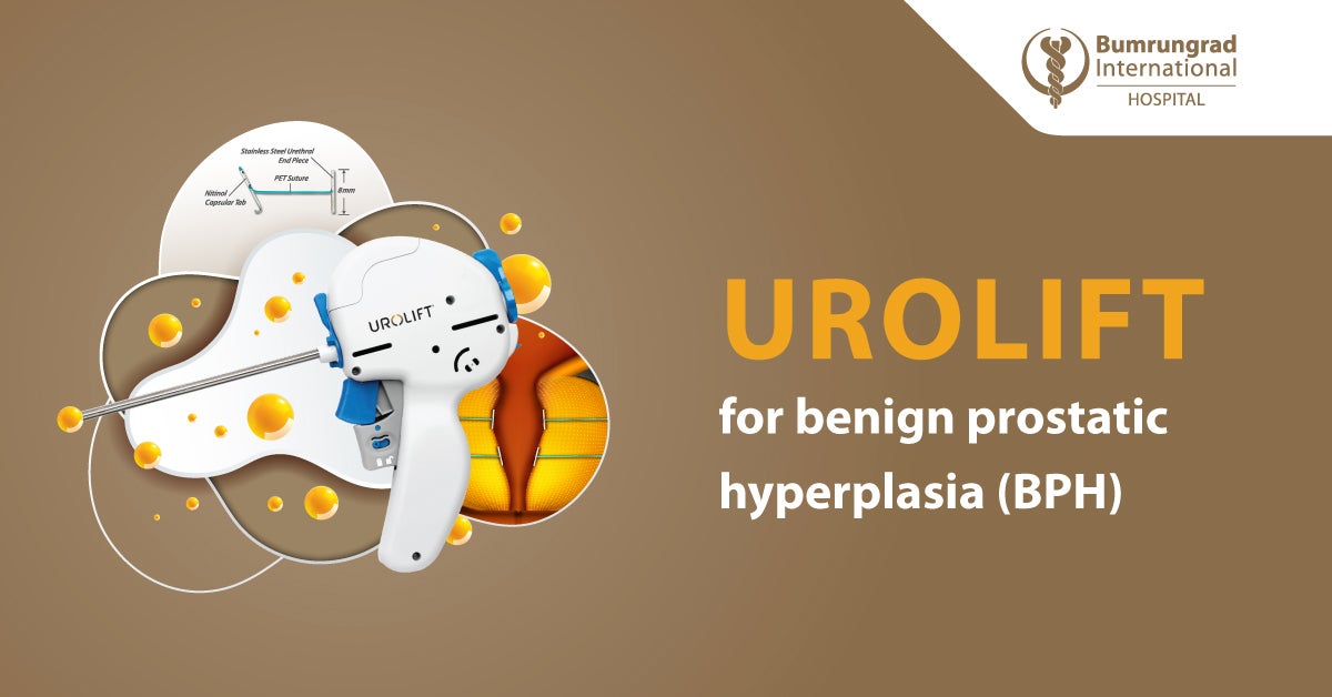 UroLift System: Інноваційне лікування доброякісної гіперплазії простати ...